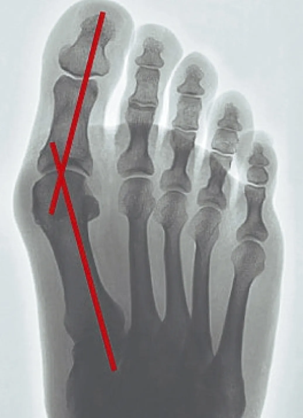 EPITACT Gesundheit & Pflege>Korrekturorthese Hallux-Valgus HAUTFARBEN